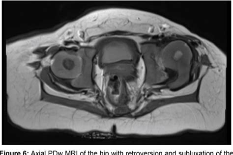 Figure 6 from MRI in Hip Dysplasia: How to Shorten your MR-Protocol ...