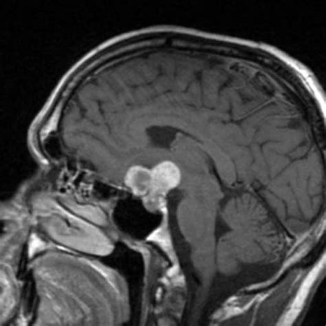 Craniopharyngioma - wikidoc