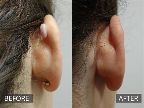 Keloid Scar Removal Treatment | The DOC Clinic Melbourne