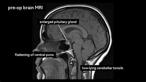 Mri Brain Tumor Pituitary