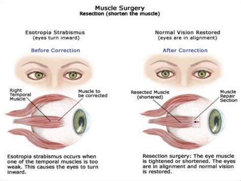 Microvascular Cranial Nerve Palsy