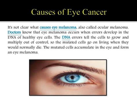 Eye Cancer (Eye Melanoma): Symptoms, Causes, Diagnosis and Treatment.