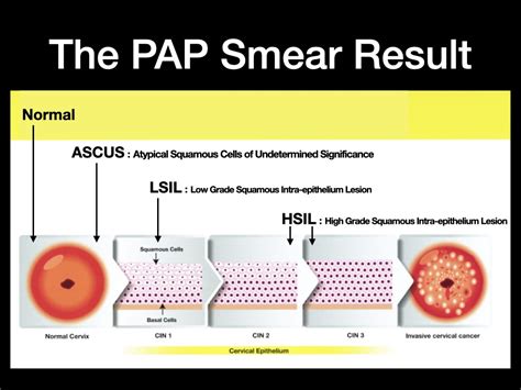 ASCUS PAP Smear & HPV - Anthony Siow