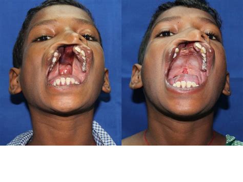 FREE CLEFT LIP AND PALATE SURGERY IN DELHI: A 12 years with a wide cleft