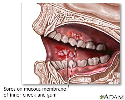 Mucous cyst Information | Mount Sinai - New York