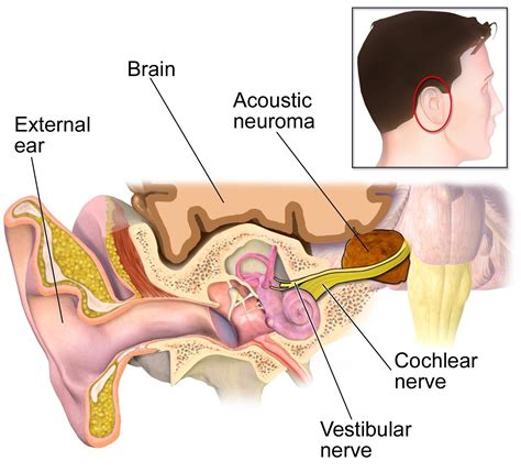 Vestibular Health — Vestibular schwannoma or acoustic neuroma