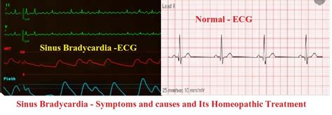 Sinus Bradycardia — Symptoms, Causes, and Its Homeopathic Treatment ...