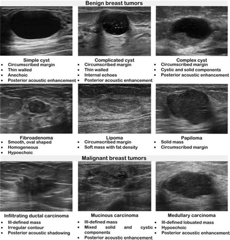 Malignant Breast Cancer On Ultrasound