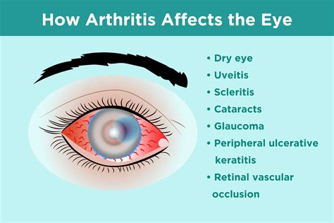 Inflammatory Arthritis and Eye Health: Prevention, Symptoms, Treatment