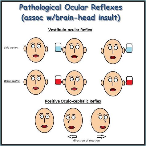 Pathological Ocular Reflexes The second one is considered the Dolls ...