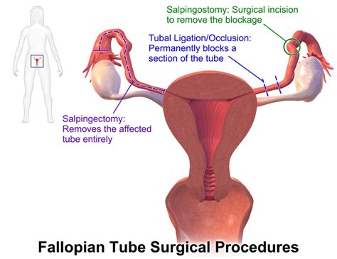 Laparoscopic Salpingectomy