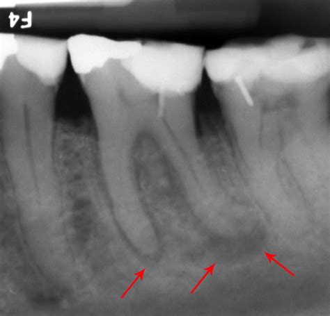 Dental abscess treatment | General center | SteadyHealth.com