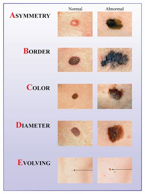 Remember the ABCDEs of Melanoma! | The Eye Associates