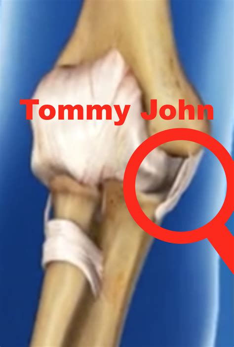 Tommy John In Baseball - ShoulderSphere