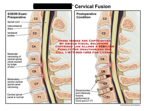 Cervical Fusion