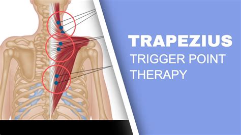 Myofascial Trigger Pain Affecting The Trapezius Muscle - El Paso, TX ...