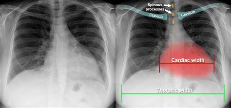 Cardiomegaly Chest Xray