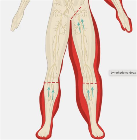 Managing Lymphedema: Vascular Surgery Associates, LLC: Vascular Surgery