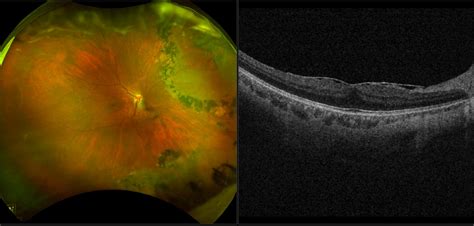 Silverstone - Epiretinal Membrane with Retinal Detachment, RG, OCT