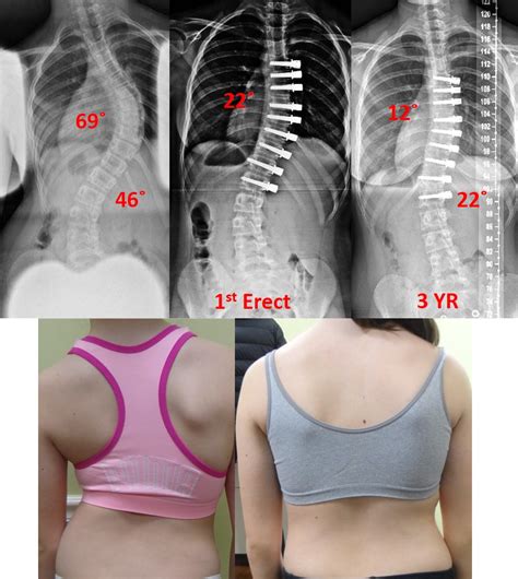 Can A Vertebral Fusion Be Reversed? Exploring Spinal Restoration Options