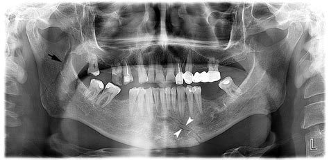 Mandibular Fracture X Ray