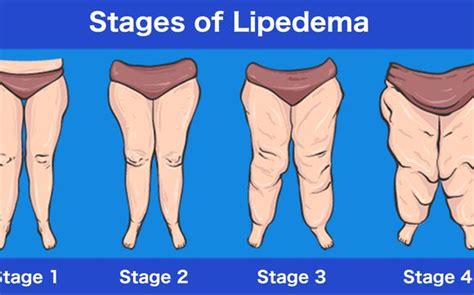 LIPEDEMA | Lipedema, Lipedema treatment, Lymphedema