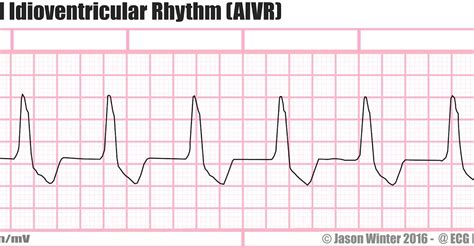 ECG Educator Blog : Accelerated Idioventricular Rhythm (AIVR)