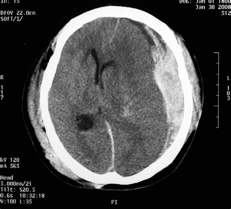 CT scan showing subdural haemorrhage