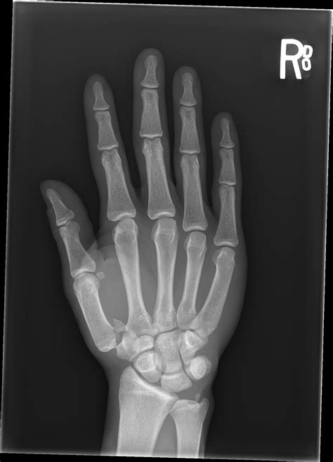 Bennett's Fracture | Resus Review