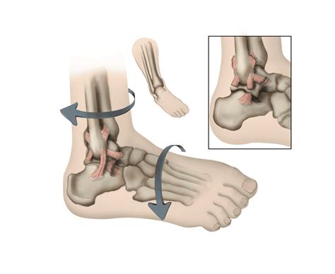 Sprained Ankle - OrthoInfo - AAOS