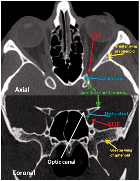 Superior Orbital Fissure Radiology