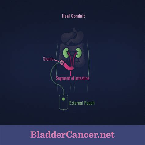 Ileal Conduit: A Common Urinary Diversion | Living with an Ileal Conduit