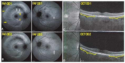 Diagnostics | Free Full-Text | Acute Zonal Occult Outer Retinopathy ...