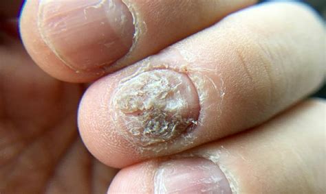 Onychomycosis (Nail Fungus) - Tran Plastic Surgery