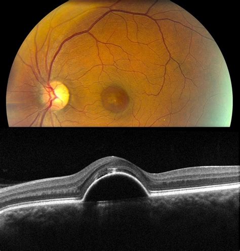 Retinal Pigment Epithelium Detachment - Retina Image Bank