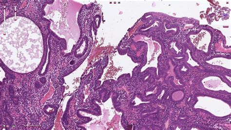 Endometrial Hyperplasia Histology