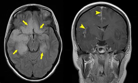 Herpes simplex encephalitis - Radiology at St. Vincent's University ...