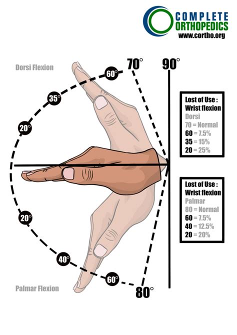 Scheduled Loss of Use for Hand and Wrist - Complete Orthopedics