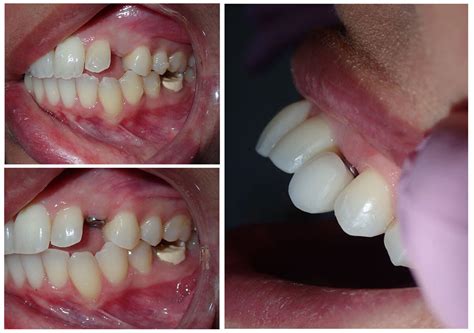 collage of three pictures showing dental implant procedure - Dental ...