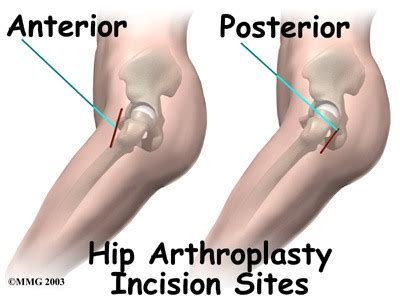 Total Hip Replacement Darlinghurst, NSW | Hip Joint Treatment Sydney