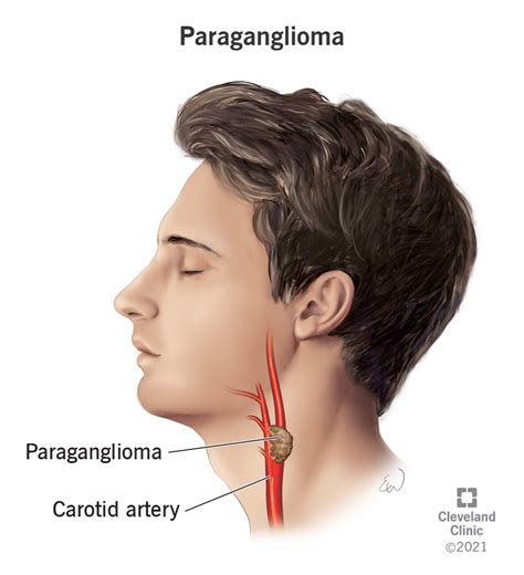 Paraganglioma: Causes, Symptoms & Treatment