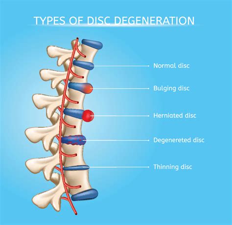 Herniated Disc What Is It And What Treatment Options Are | Free Nude ...