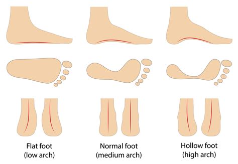 How to Know if You Have High Arch Feet - Hendrickson Carapt