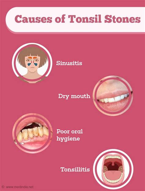 Tonsil Stones - Causes, Symptoms, Diagnosis, Treatment and Prevention