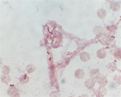 Gram-staining of blood culture showing Gram-negative small coccobacilli ...