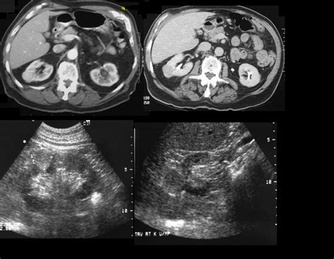 Renal Cell Carcinoma Kidney Cancer