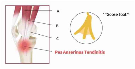 Injections for Pes Anserine Tendinopathy | Steroid Injections For Pes ...