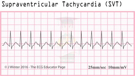 ECG Educator Blog : Atrial Rhythms