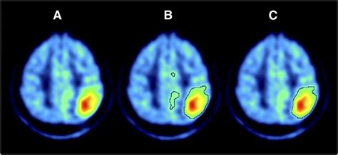 Voxel-Based Analysis of Dual-Time-Point 18F-FDG PET Images for Brain ...