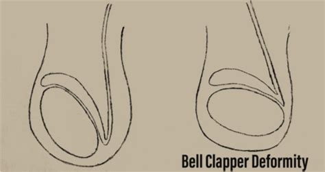 Testicular Torsion - CanadiEM